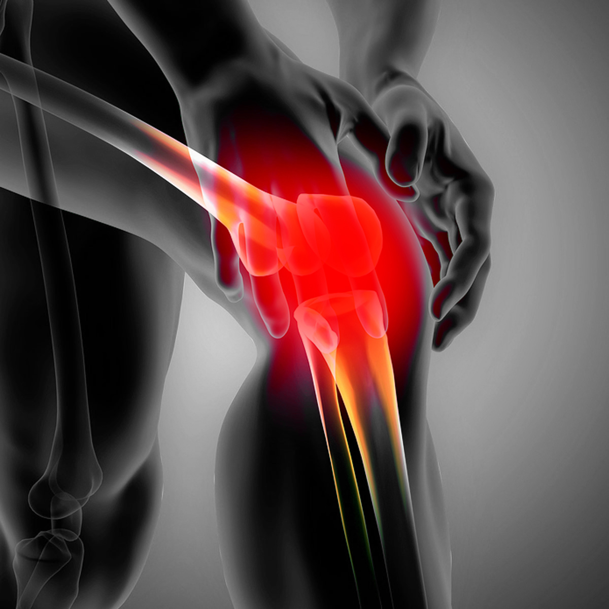 Osteoarthritis (OA) NJSM